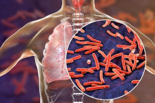 Kasus Penyakit TBC Tinggi, Capaian Terapi Pencegahan Masih Rendah