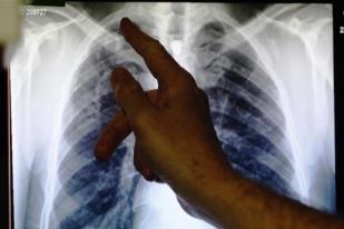 Pakar: COVID-19 Mungkin Akibatkan Kerusakan Panjang pada Paru-paru