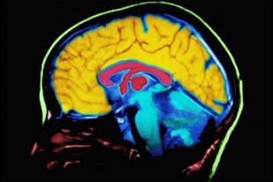 Terapi Magnet Untuk Menstimulasi Otak Penderita Stroke