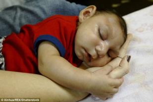 Bayi di Texas Meninggal karena Mikrosefalus Terkait Zika
