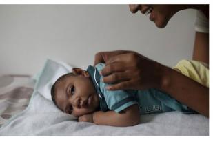 Thailand Konfirmasi Kasus Bayi dengan Mikrosefalus Pertama