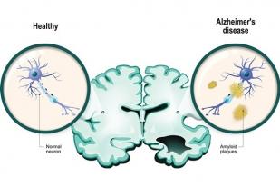 Waspadai 10 Gejala Demensia Alzheimer