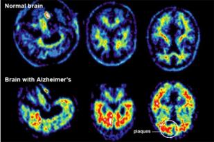 Membedakan Gejala Alzheimer dan Penyakit Saraf Lainnya 