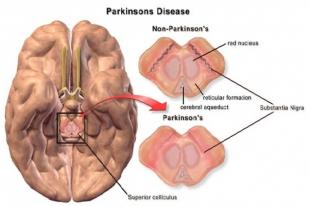Australia Kembangkan Hidrogel untuk Lawan Parkinson